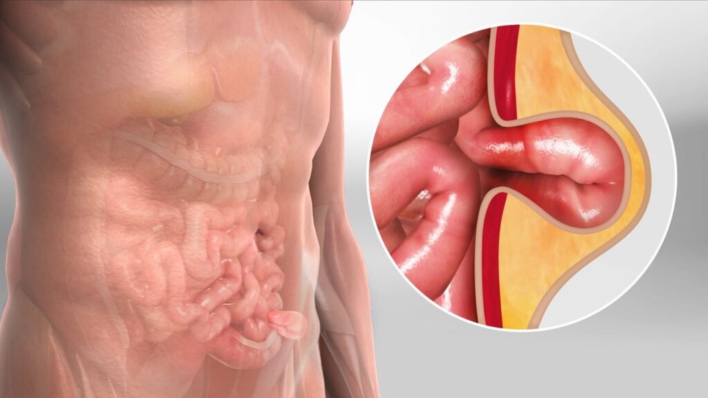 hernia treatment in noida