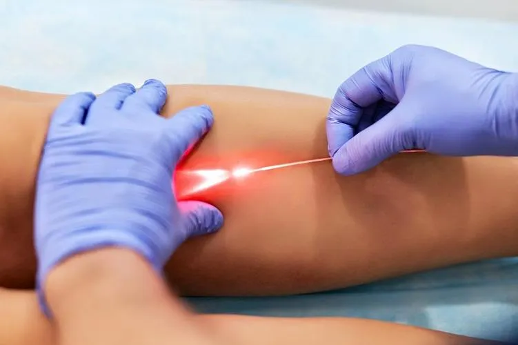 laser varicose vein surgery