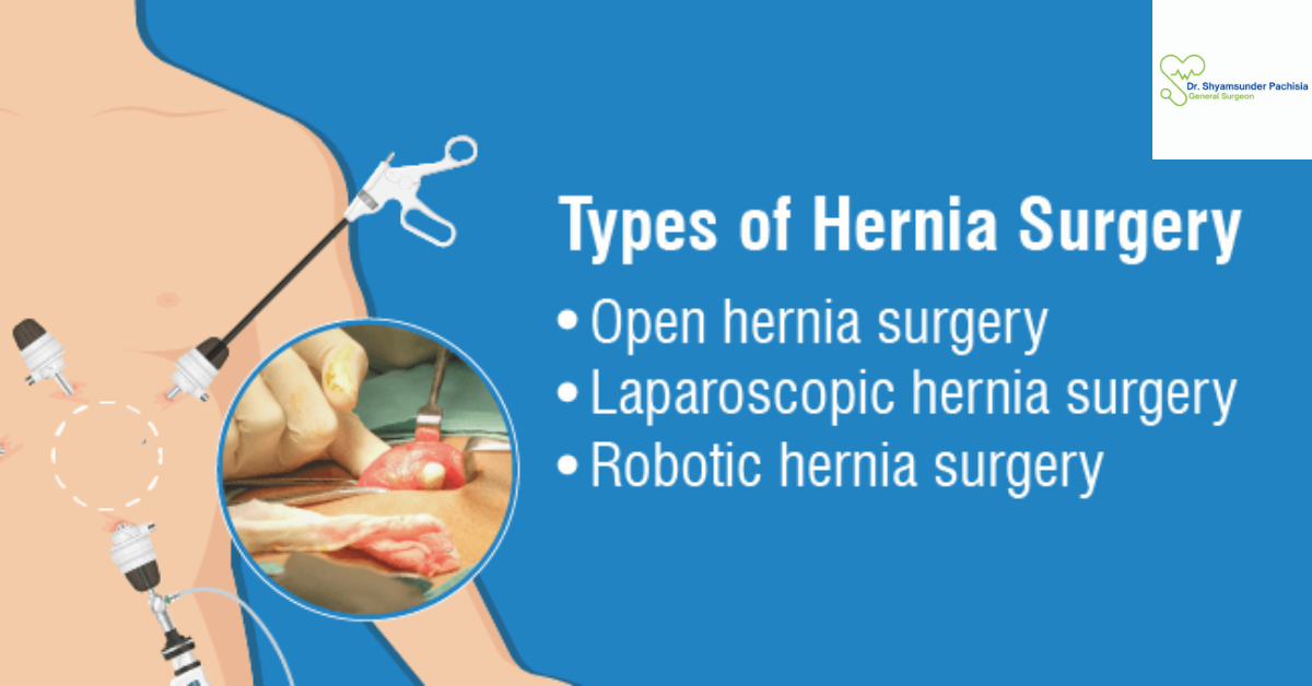 hernia surgery in Noida