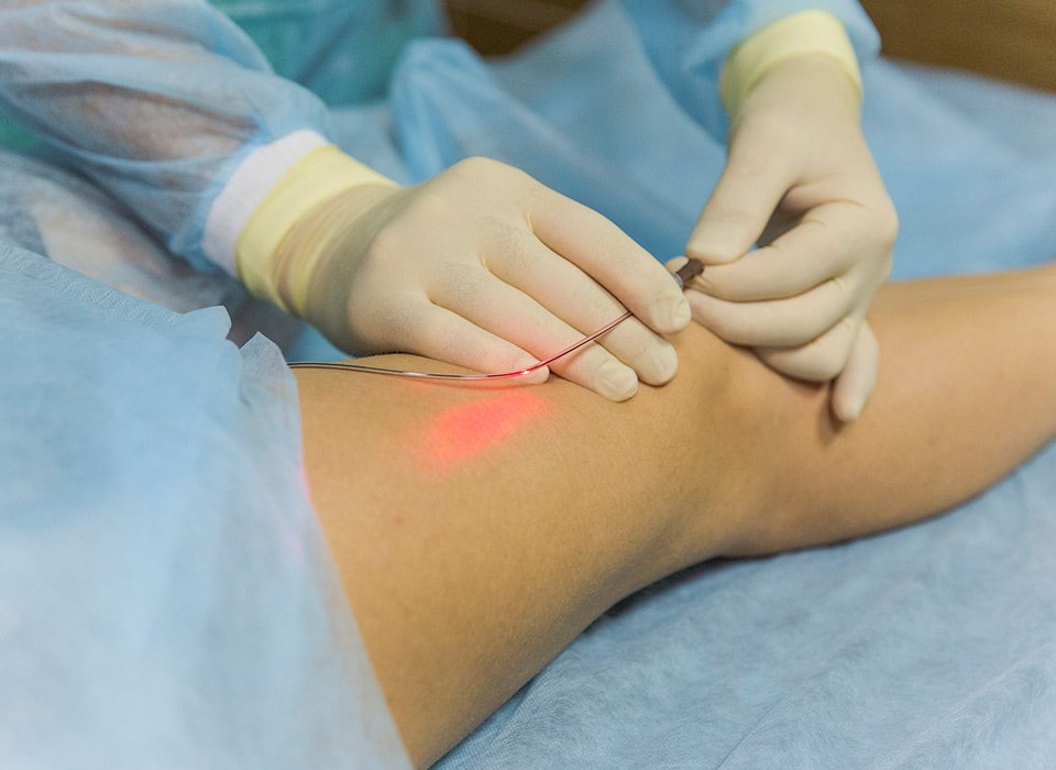 Laser Varicose vein surgery